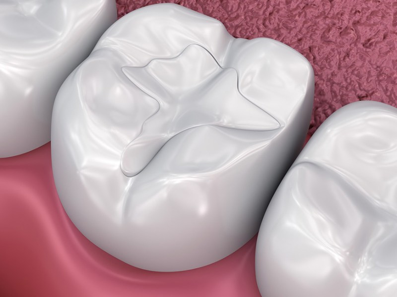 How White Tooth Fillings Blend Seamlessly for Aesthetic&nbsp;Perfection